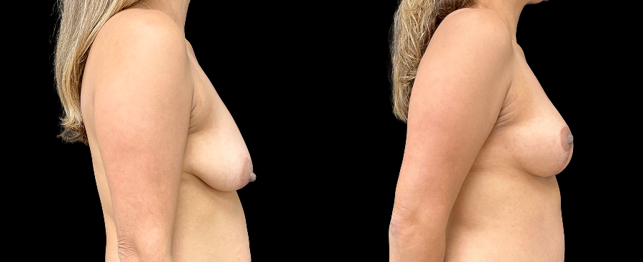 Breast lift results, side right view – case 4