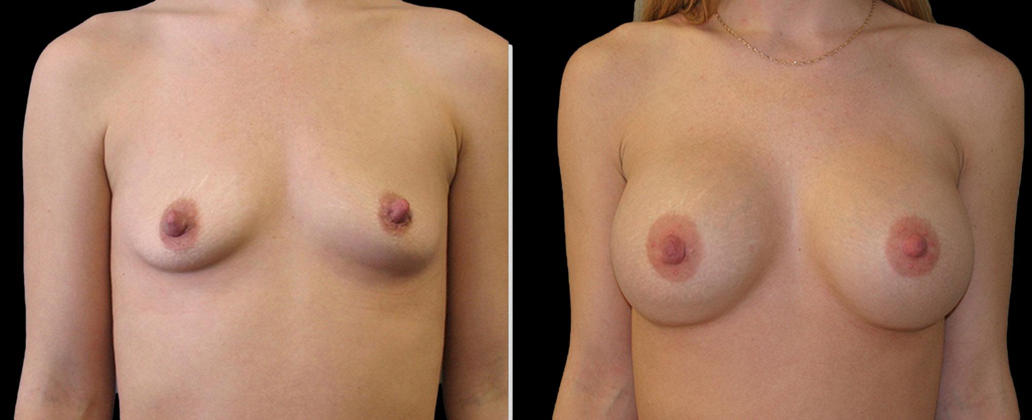before and after breast augmentation
