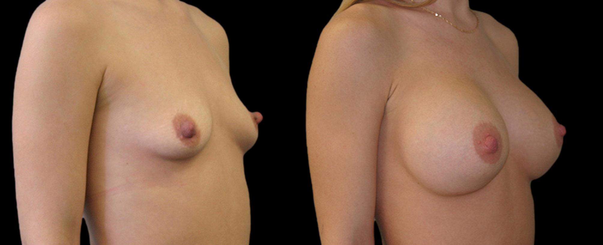 before and after breast augmentation