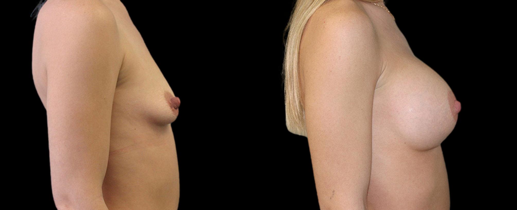 before and after breast augmentation