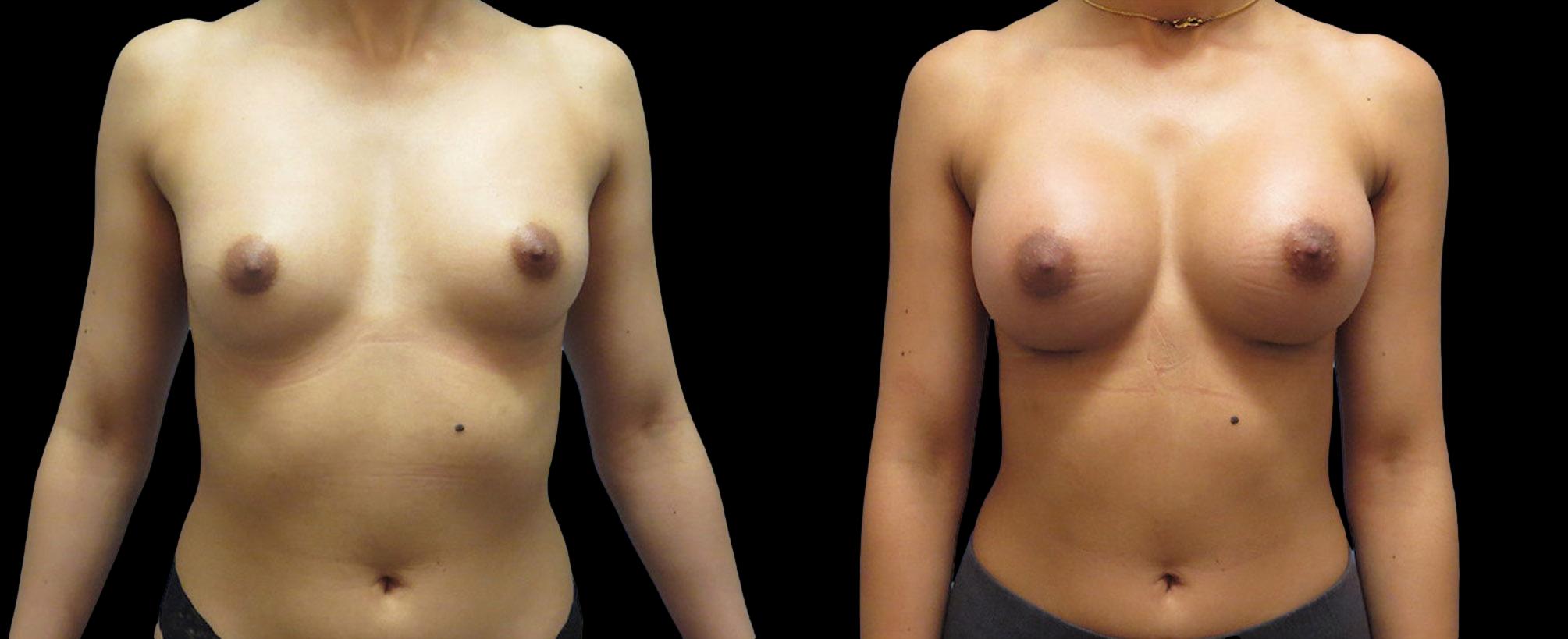 before and after breast augmentation