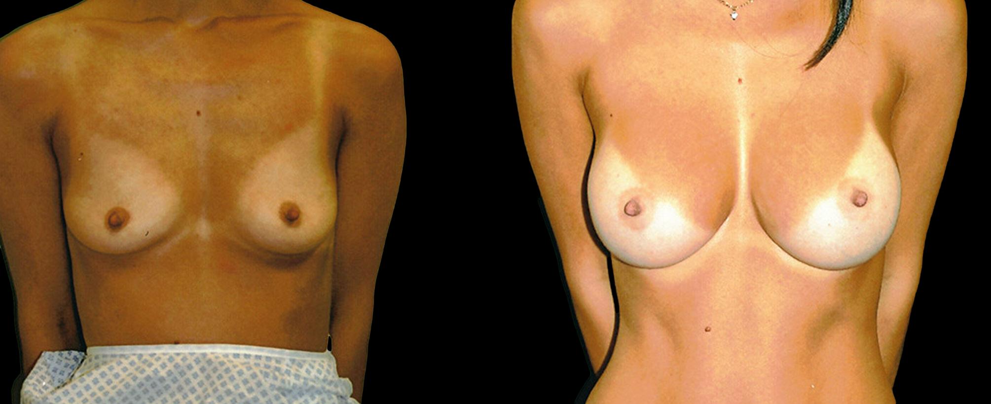 before and after breast augmentation