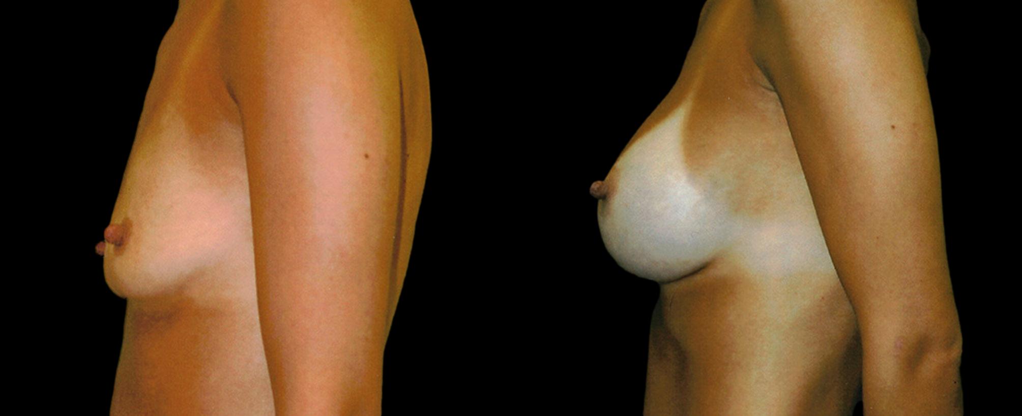 before and after breast augmentation