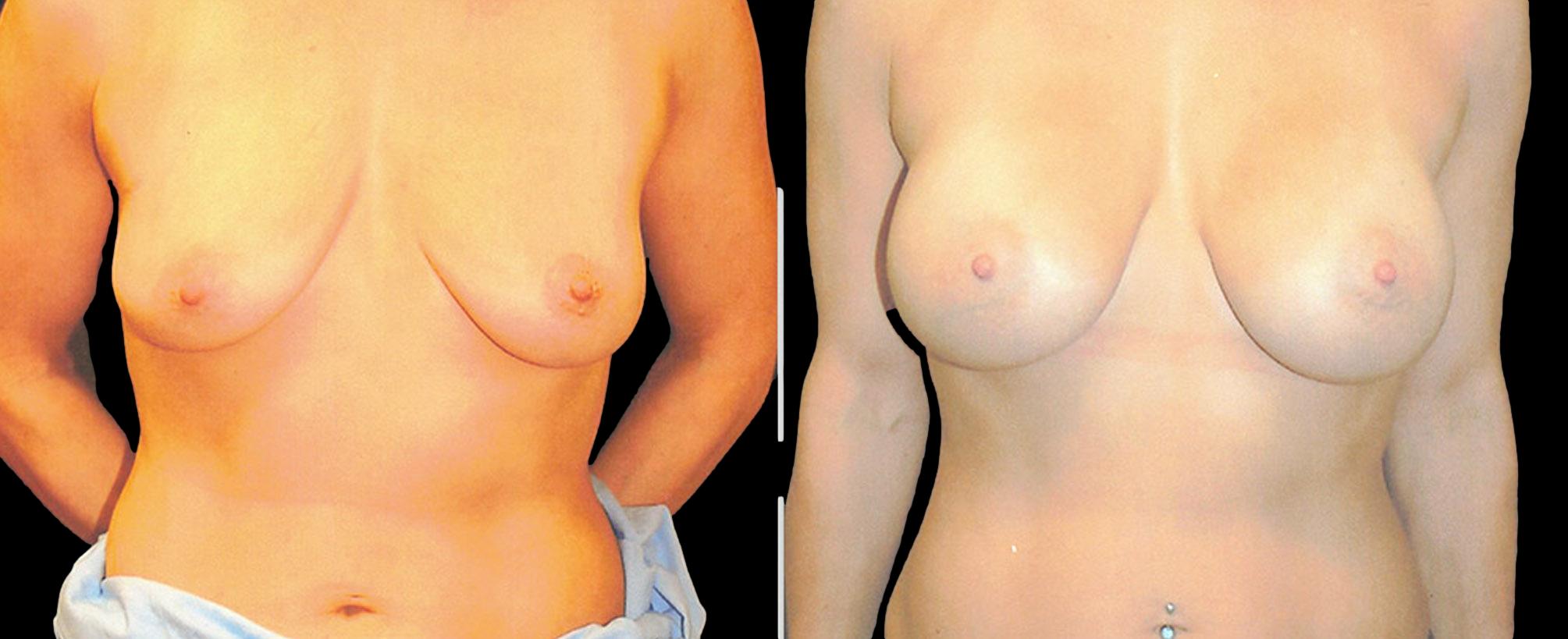 before and after breast augmentation
