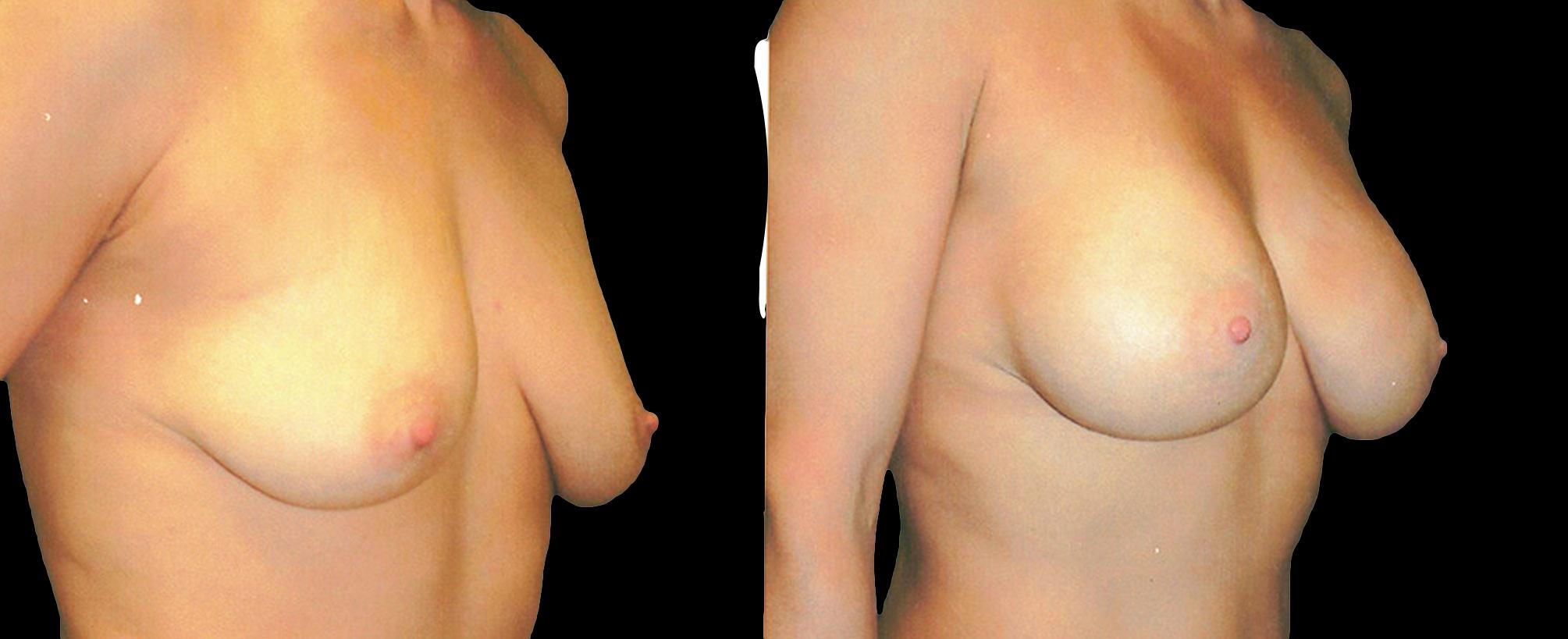 before and after breast augmentation