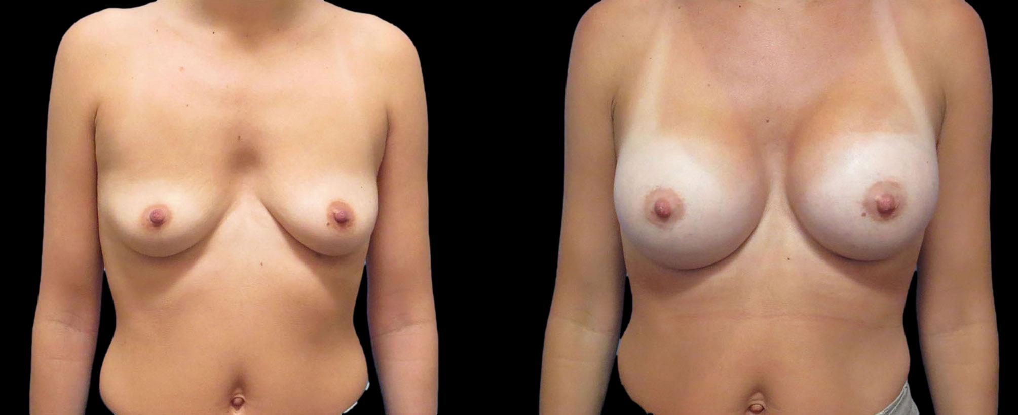 before and after breast augmentation