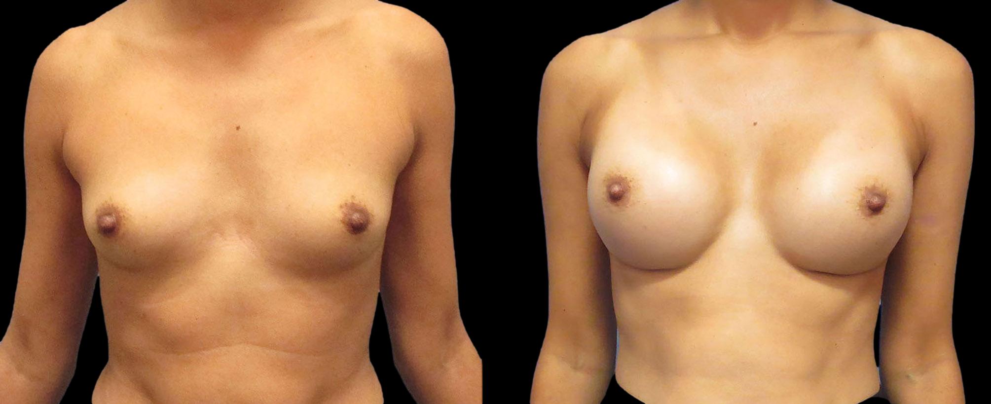 before and after breast augmentation