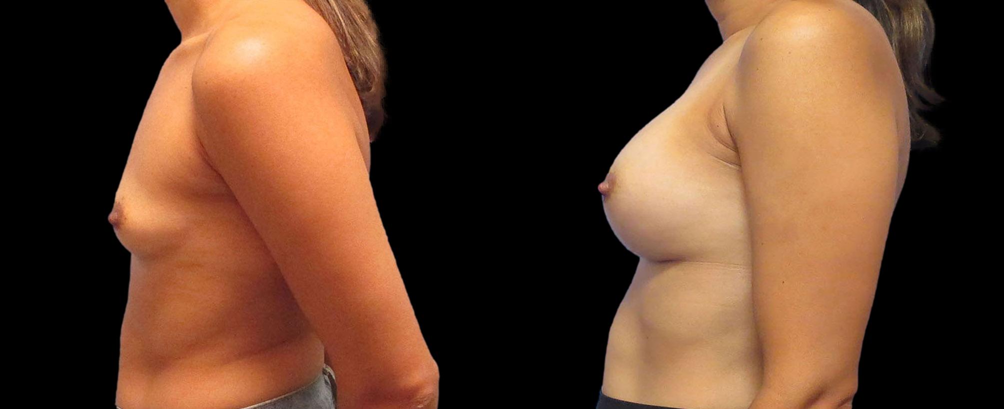 before and after breast augmentation