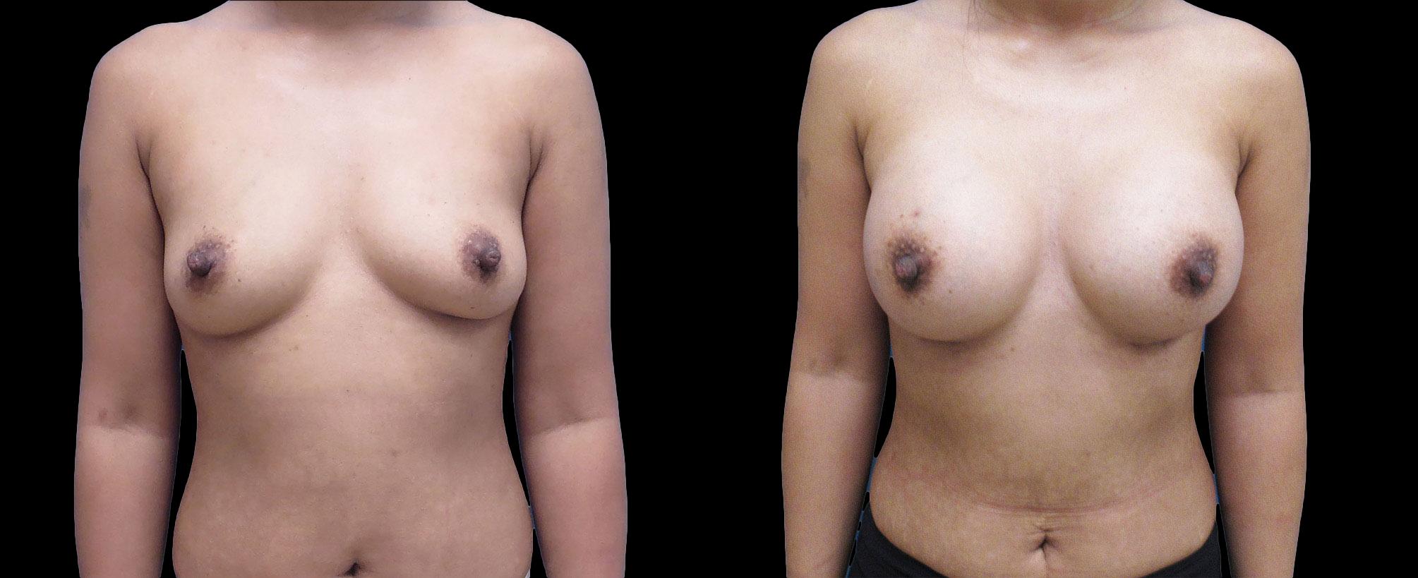 before and after breast augmentation