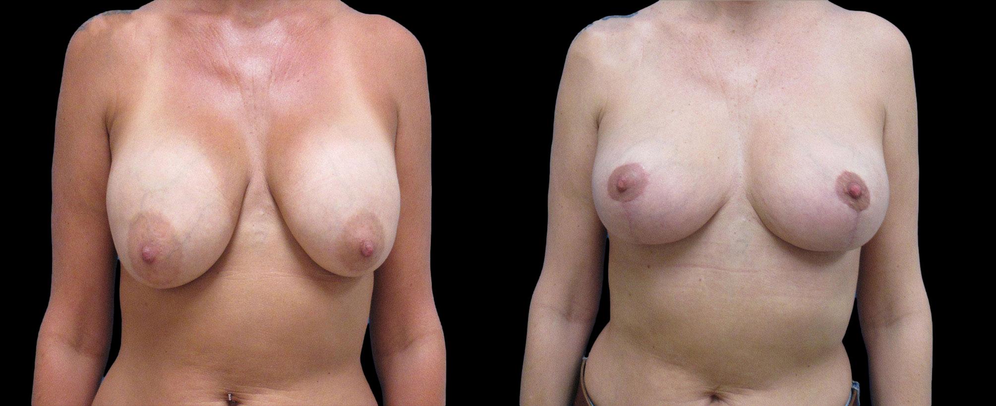 before and after breast lift with implants