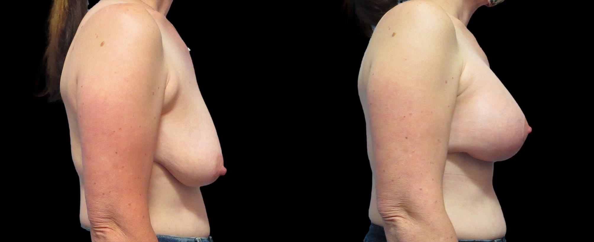 before and after breast lift with implants