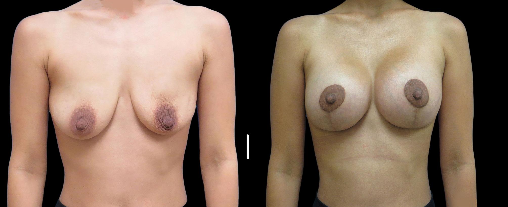 before and after breast lift with implants