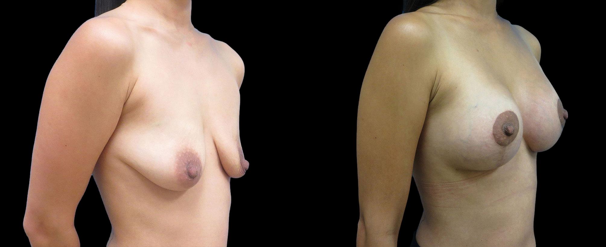 before and after breast lift with implants