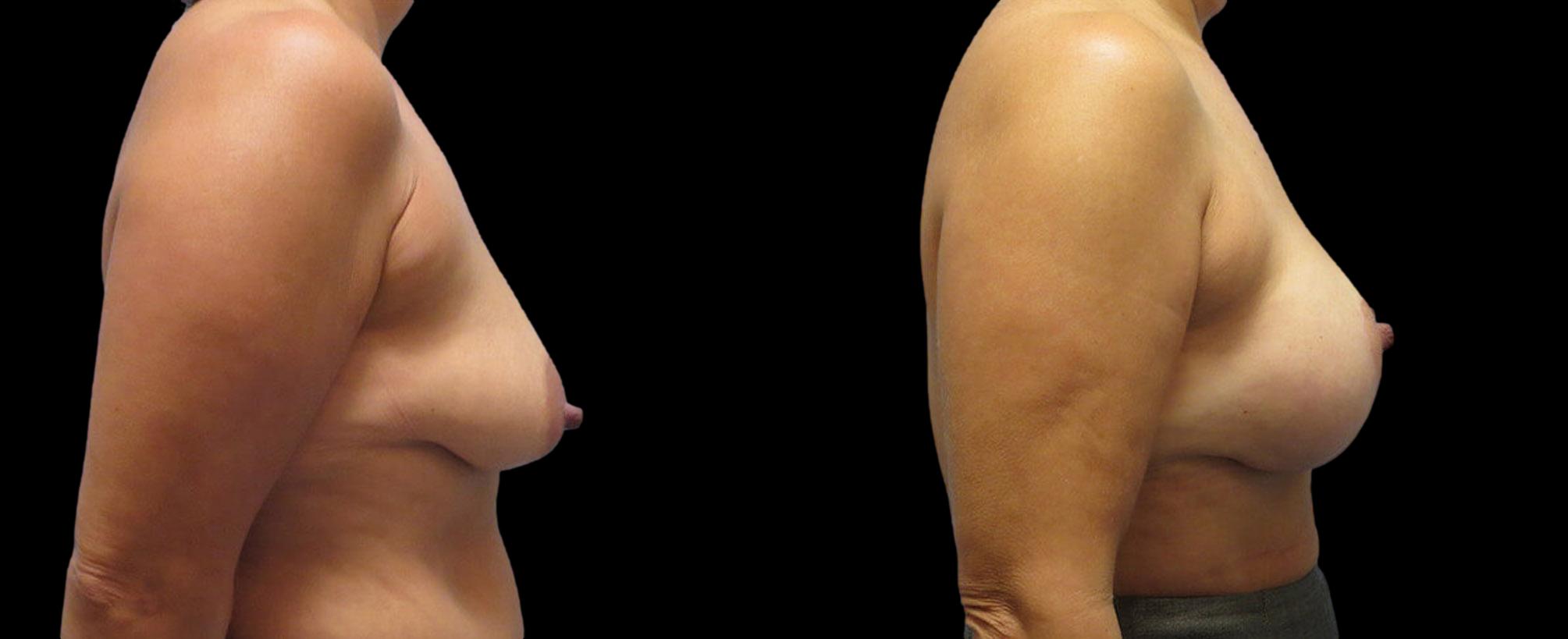 before and after breast lift with implants
