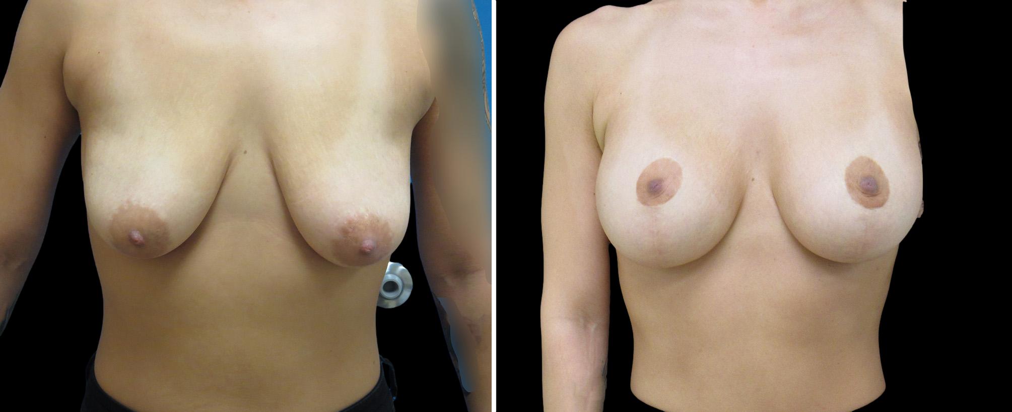 before and after breast lift with implants
