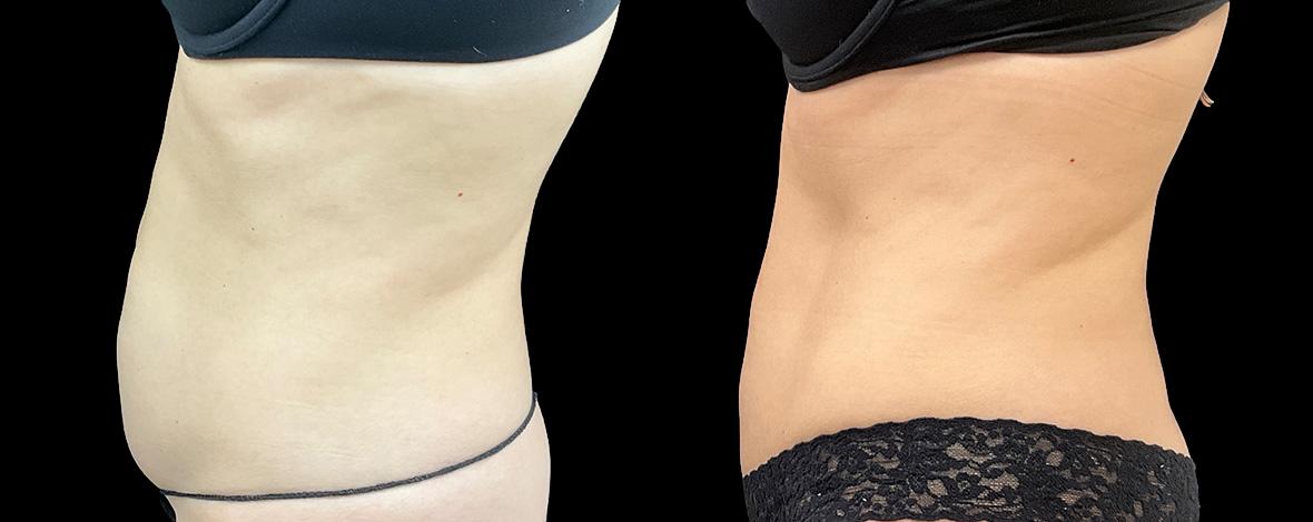 before and after evolvex