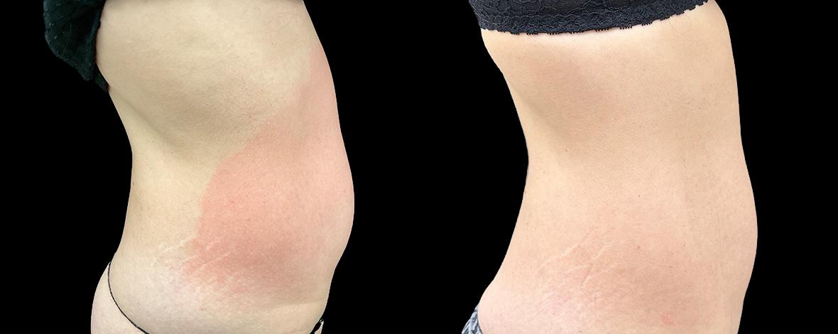 before and after evolvex