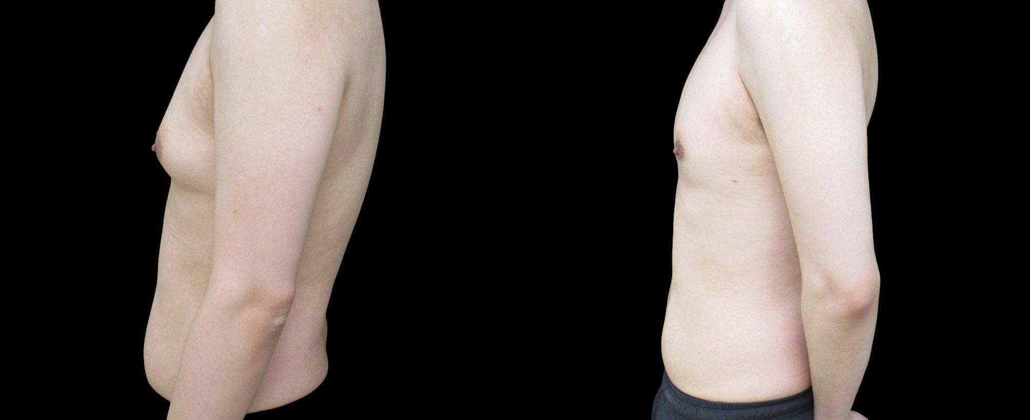 before and after gynecomastia
