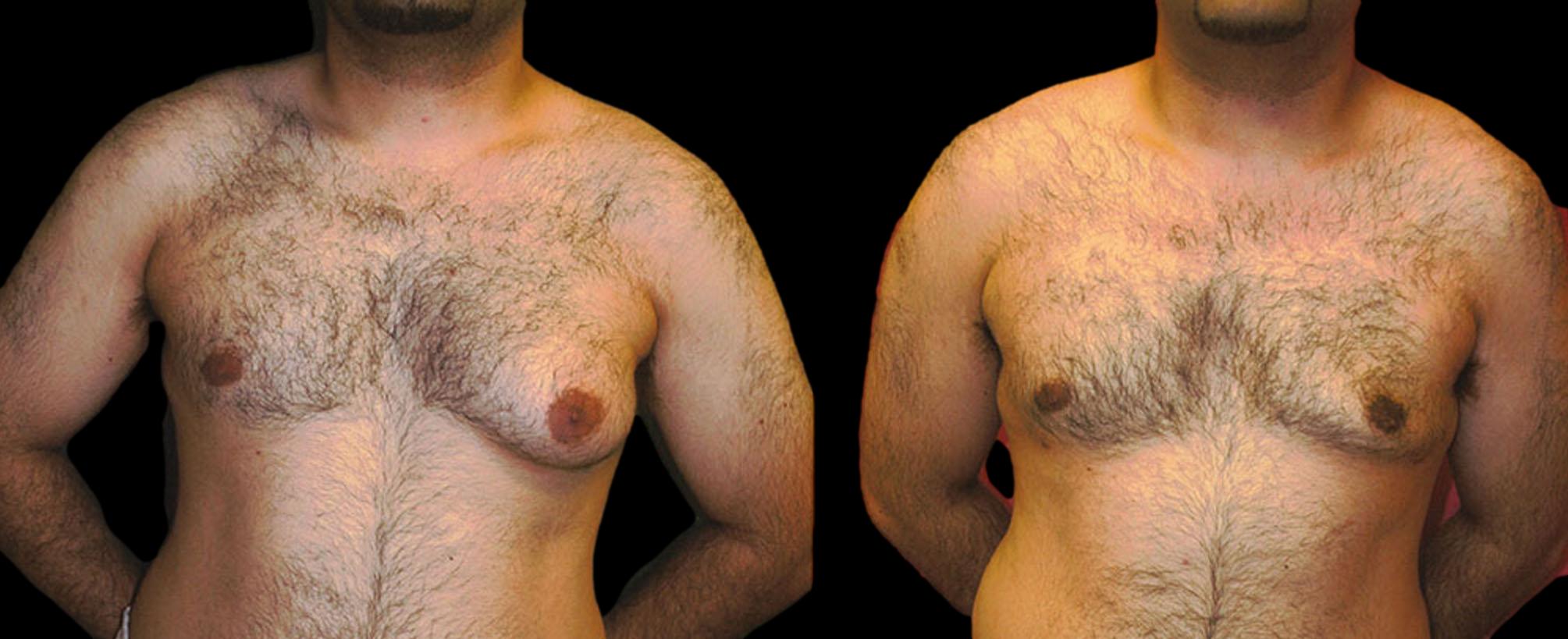 before and after gynecomastia