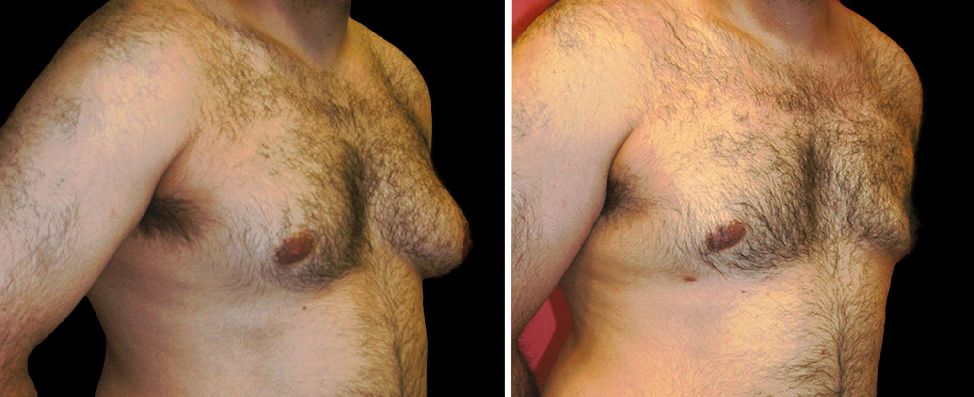 before and after gynecomastia