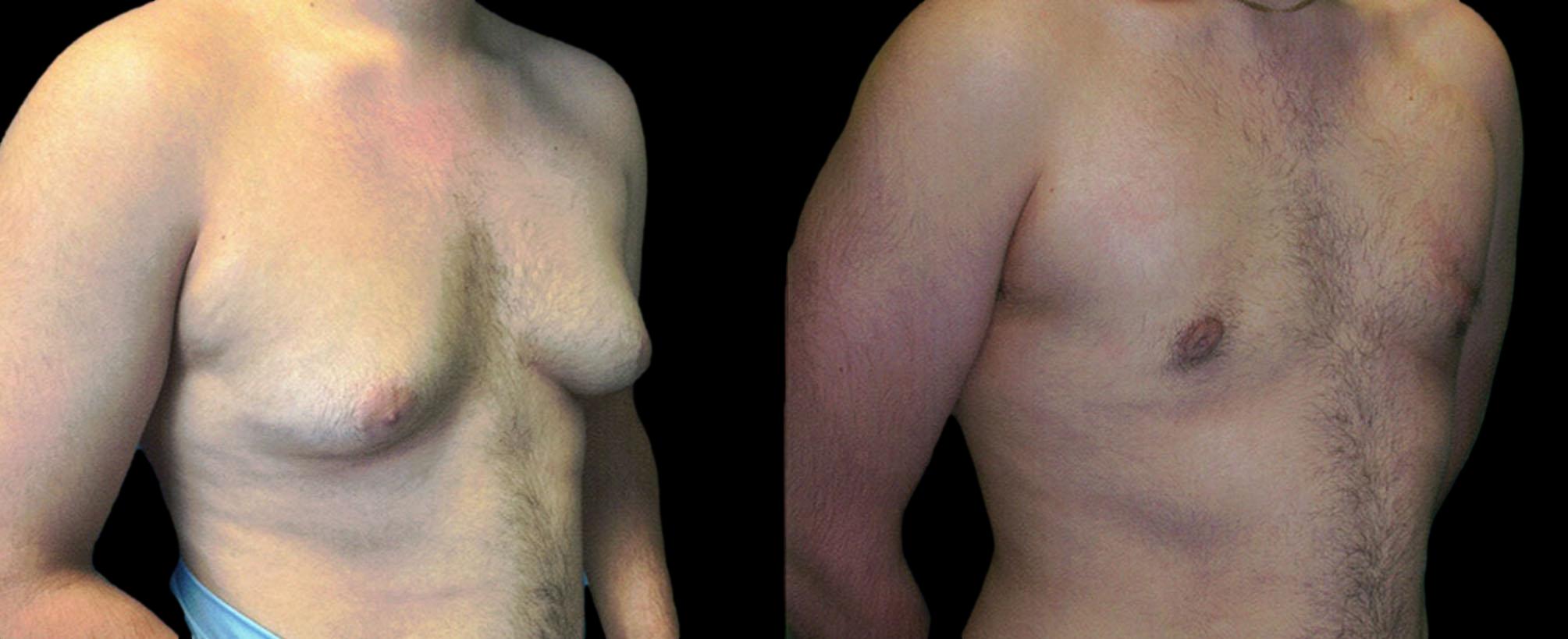 before and after gynecomastia