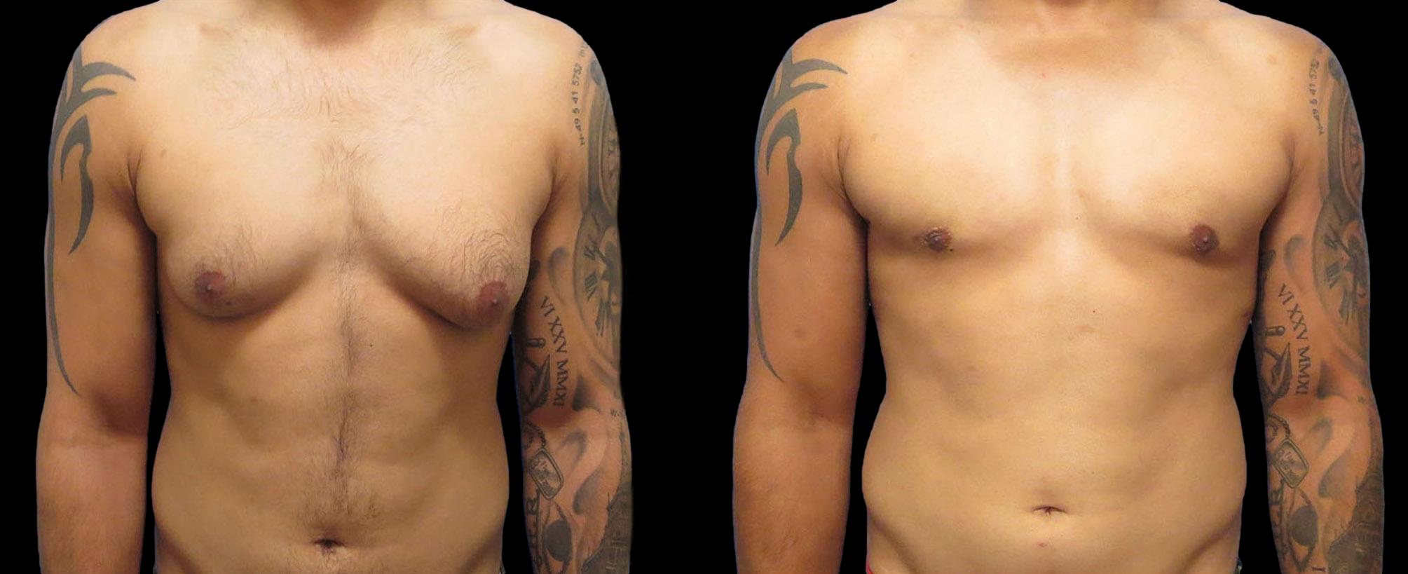 before and after gynecomastia