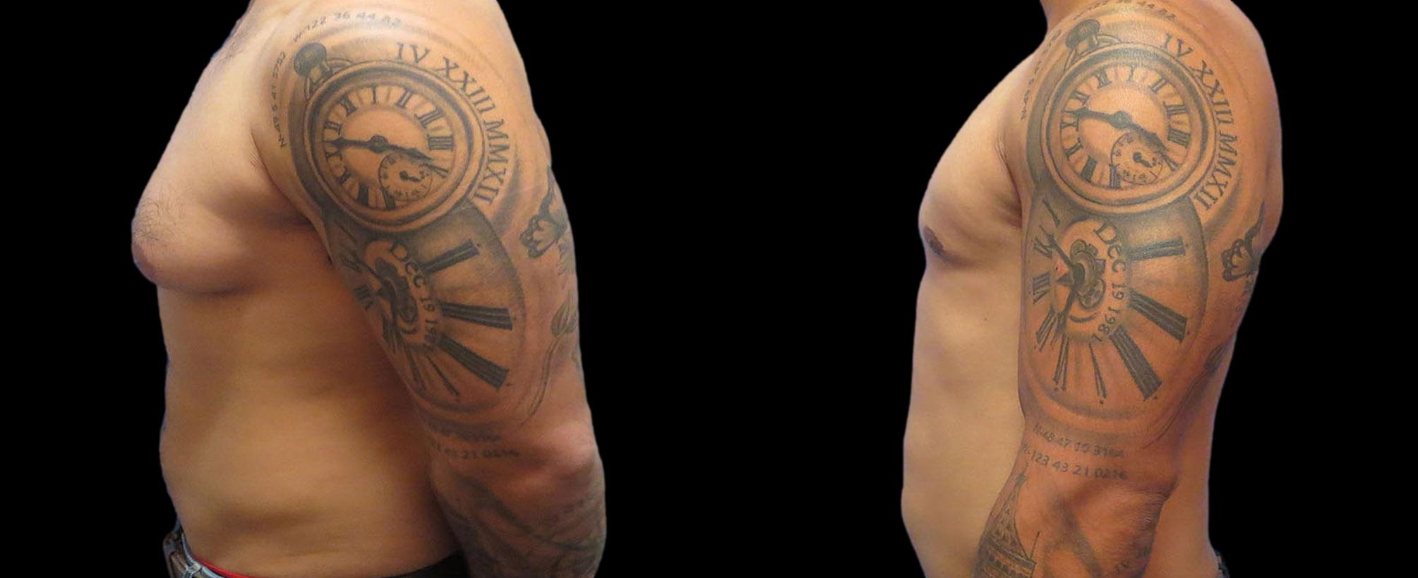 before and after gynecomastia