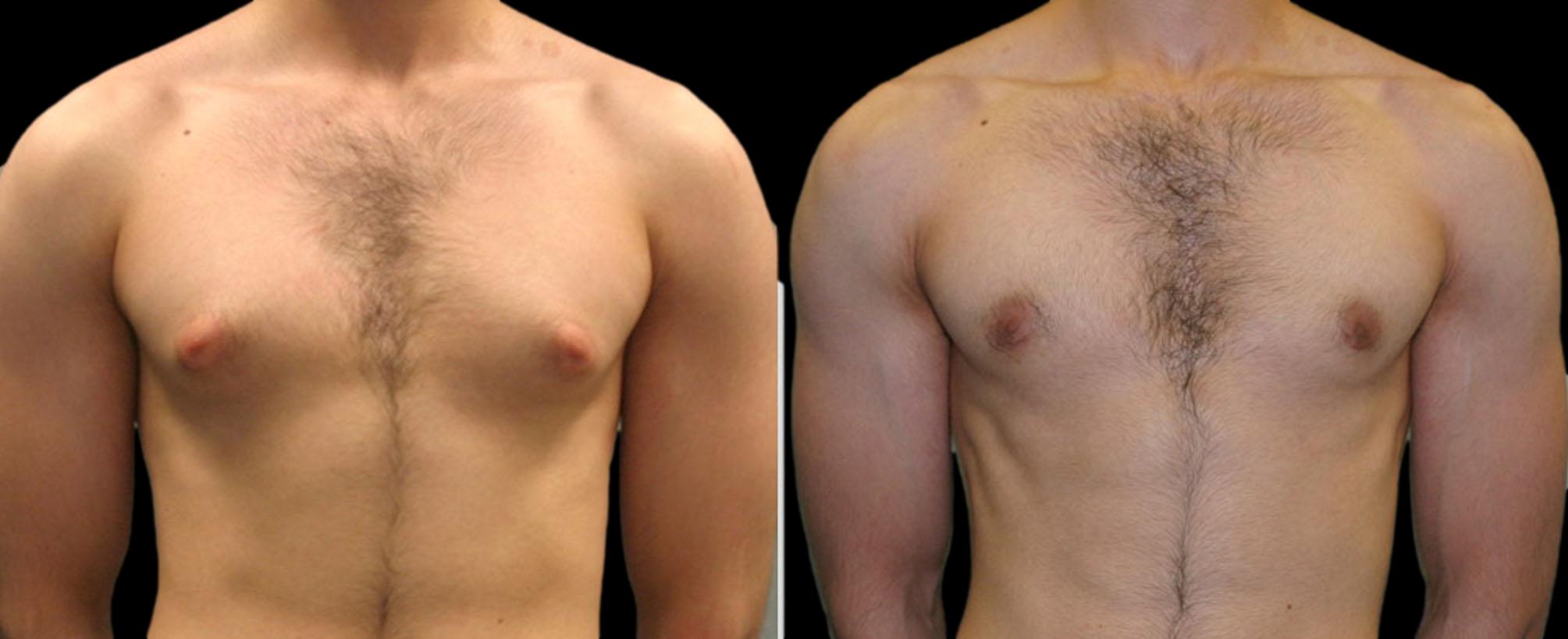 before and after gynecomastia