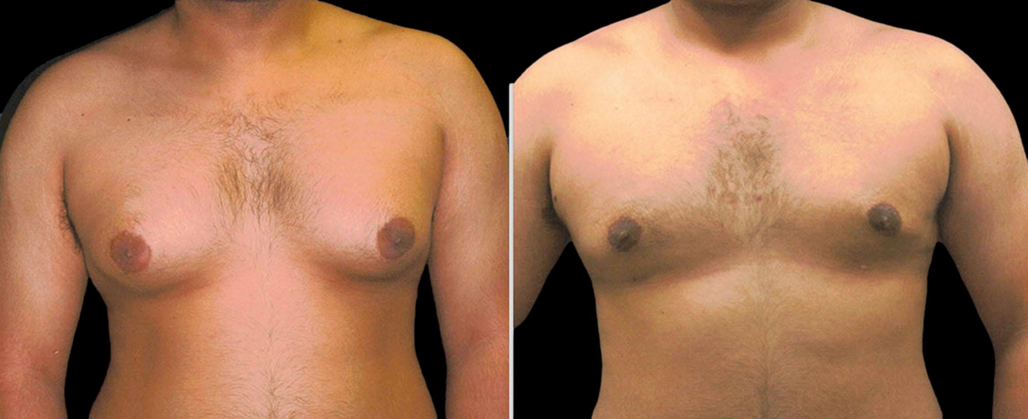 before and after gynecomastia
