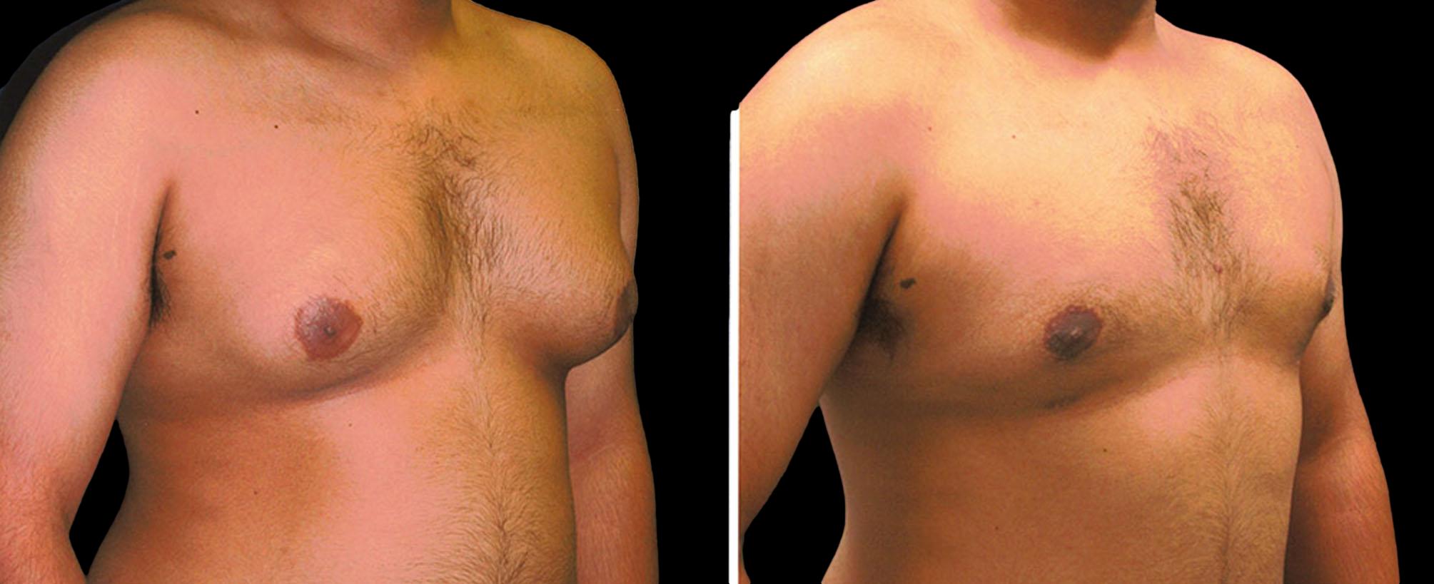before and after gynecomastia