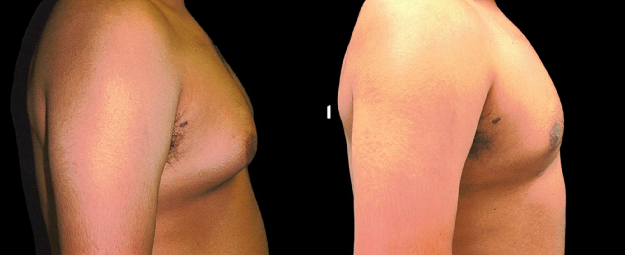 before and after gynecomastia