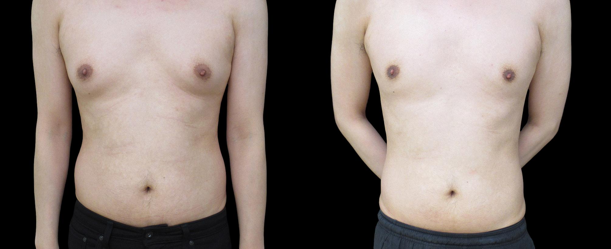 before and after gynecomastia