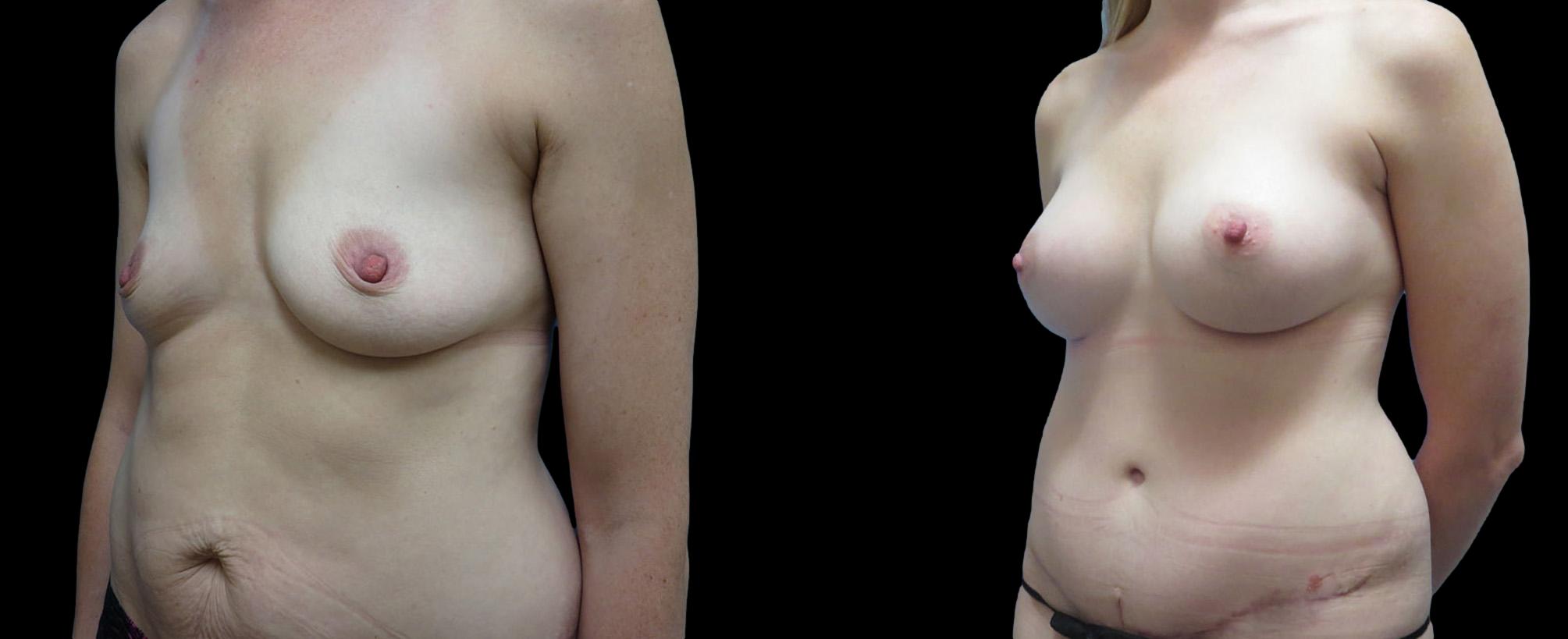 before and after mommy makeover