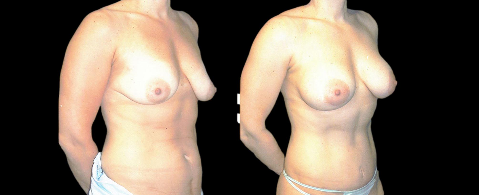 before and after mommy makeover
