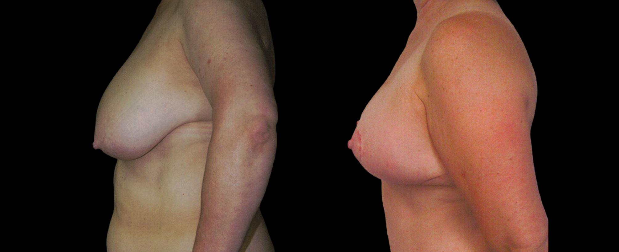 before and after mommy makeover