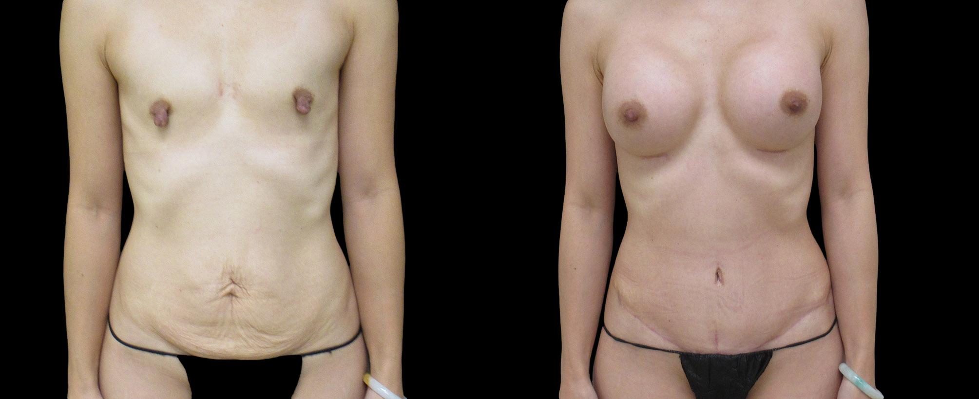 before and after mommy makeover