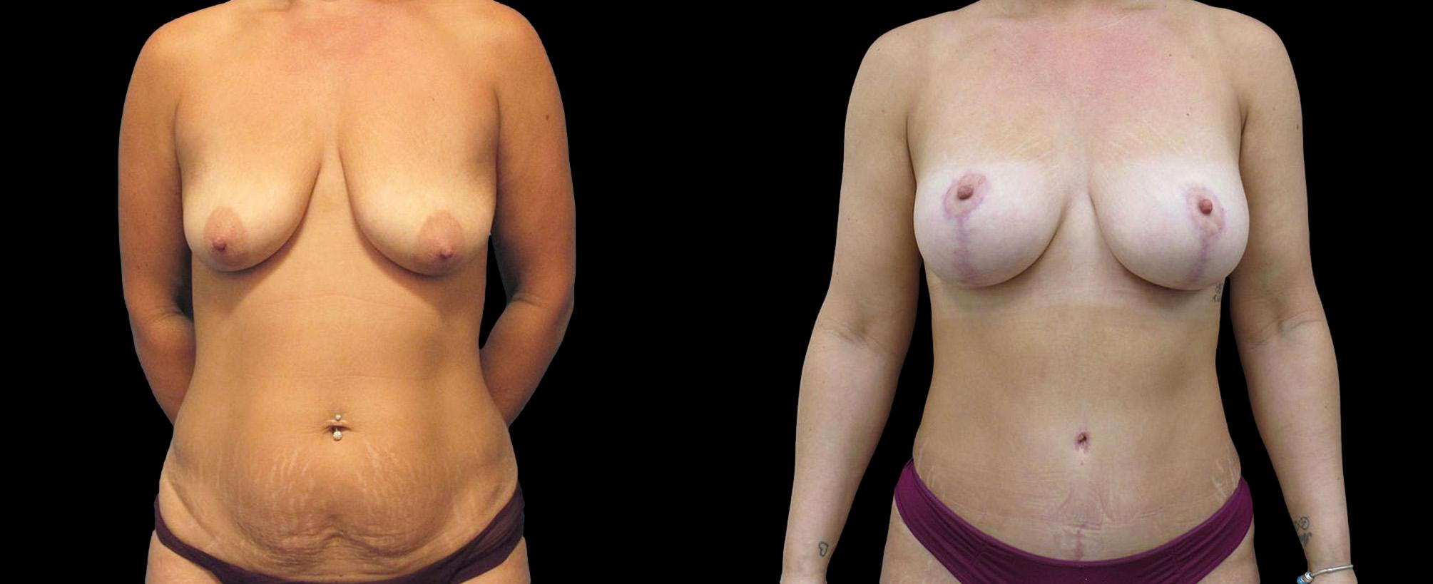 before and after mommy makeover
