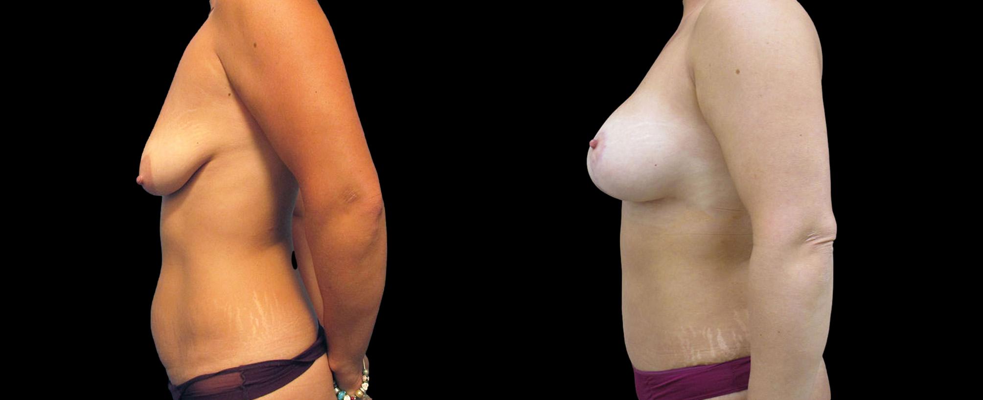 before and after mommy makeover