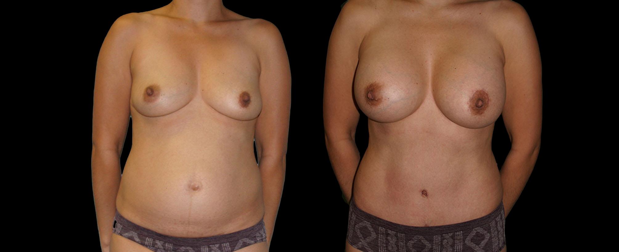 before and after mommy makeover