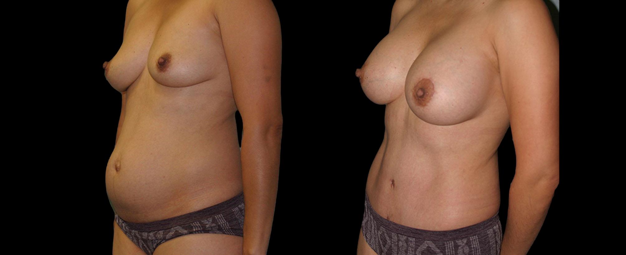 before and after mommy makeover