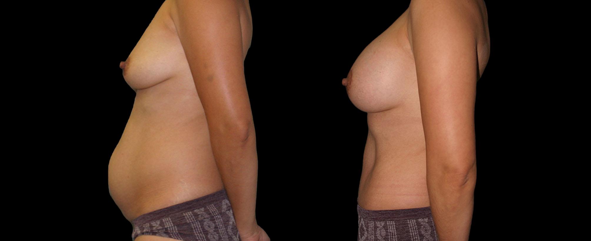 before and after mommy makeover