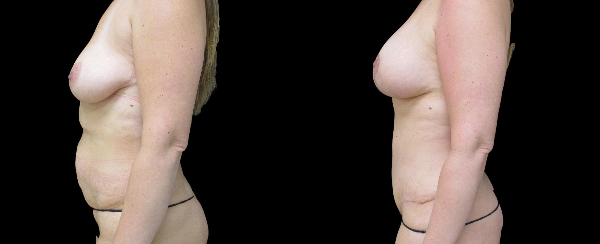 before and after mommy makeover