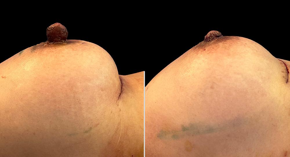 before and after nipple reduction