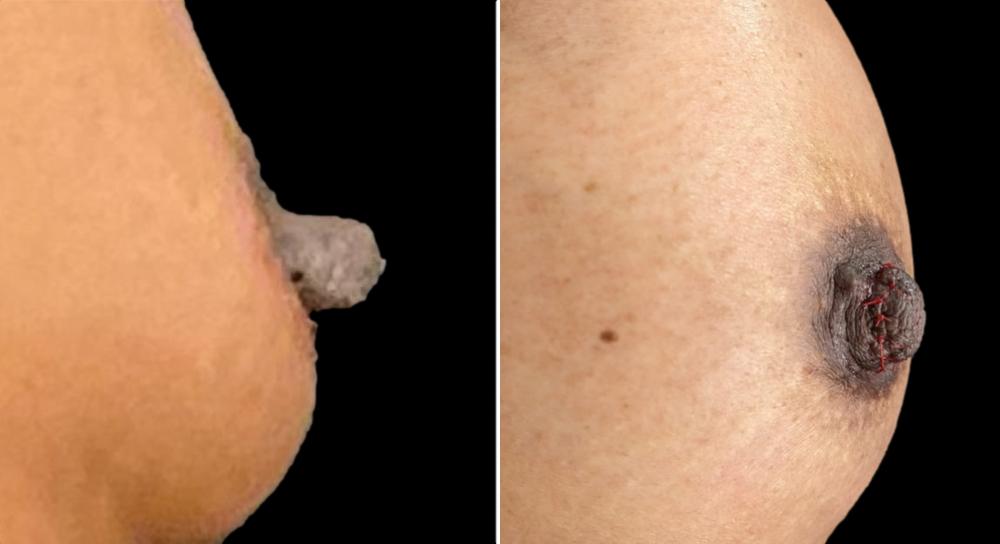 before and after nipple reduction