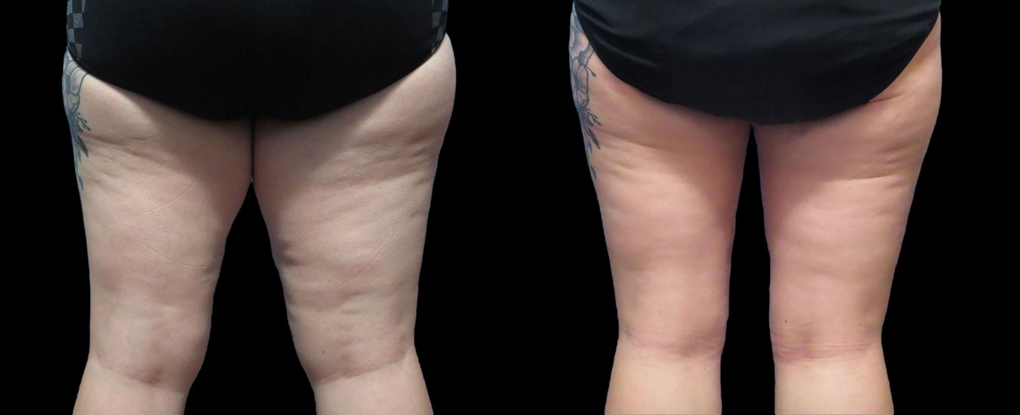before and after thigh lift