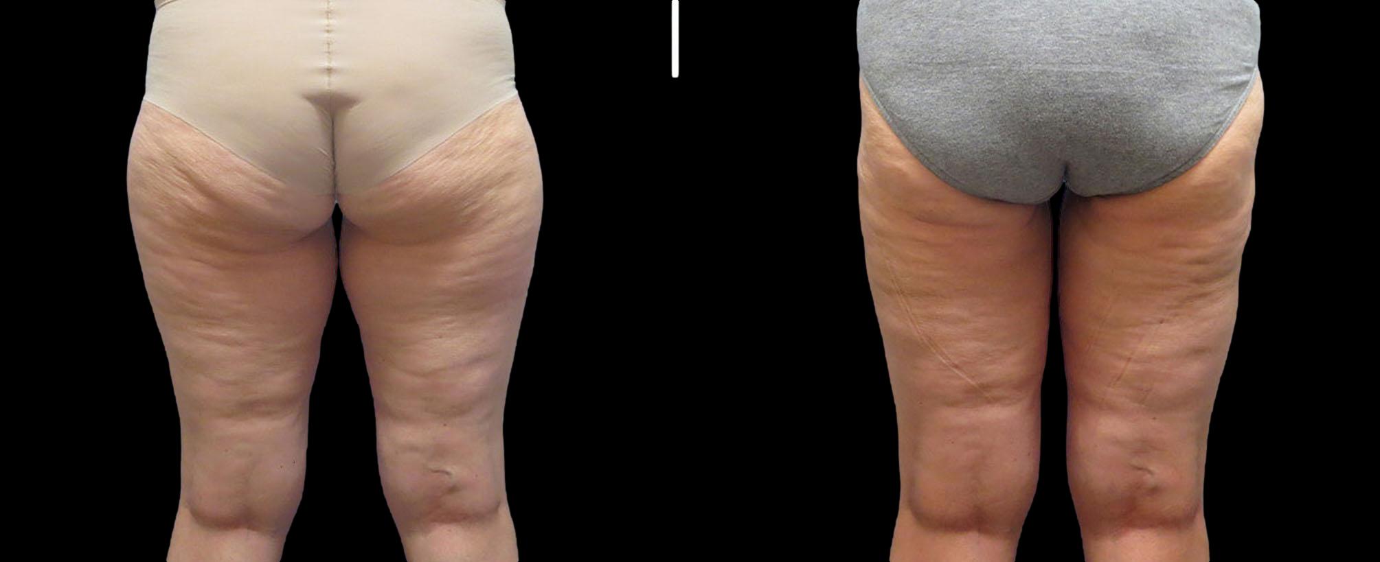 before and after thigh lift