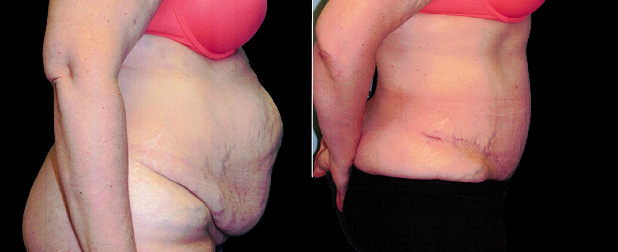 before and after abdominoplasty / tummy tuck