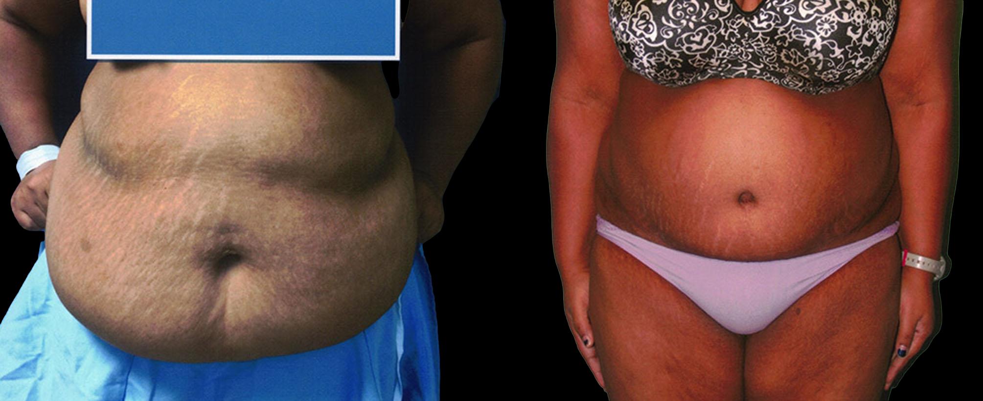 before and after abdominoplasty / tummy tuck