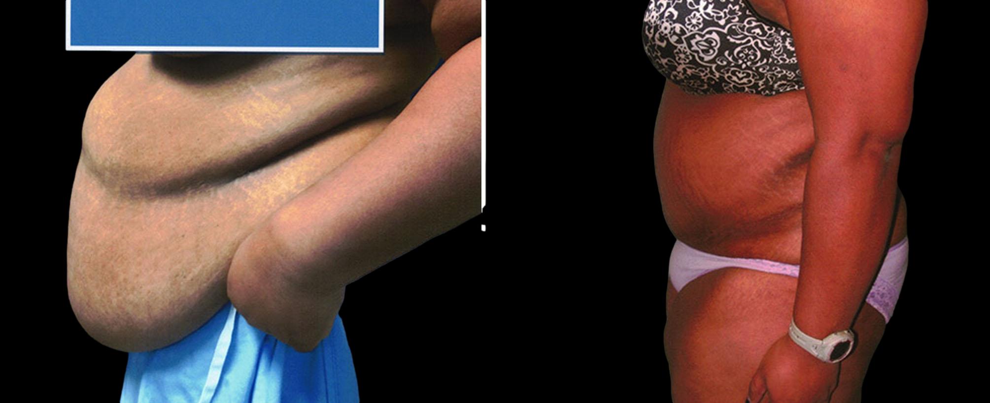 before and after abdominoplasty / tummy tuck