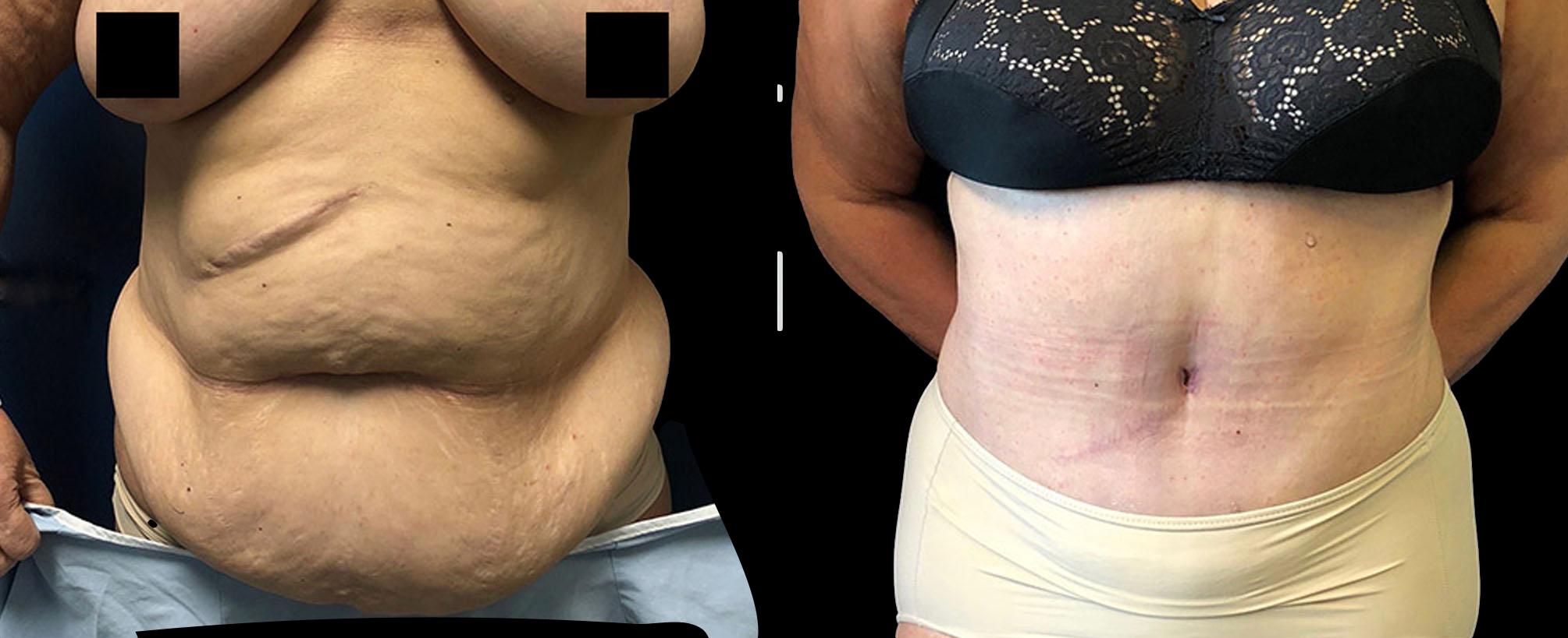 before and after abdominoplasty / tummy tuck